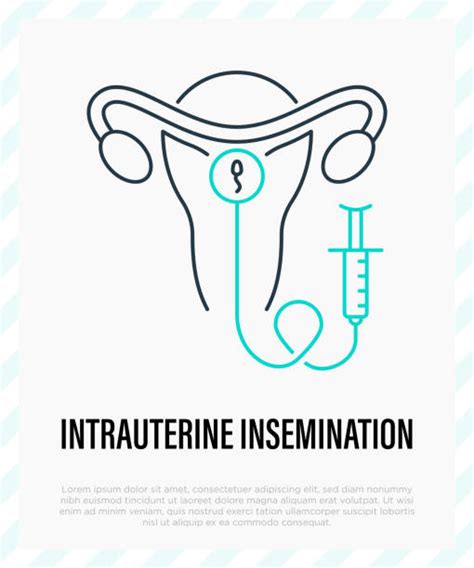 Illustrazione dettagliata del processo di inseminazione intrauterina