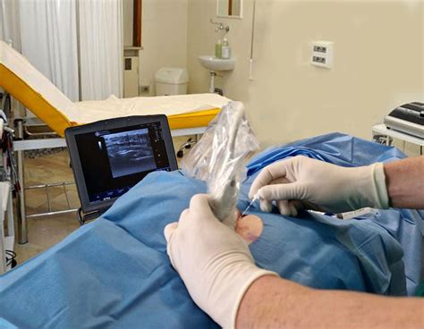 Anatomia dello iato sacrale e schema di infiltrazione caudale ecoguidata