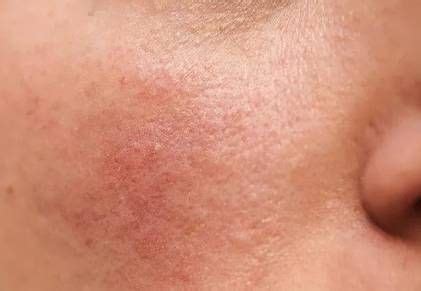 Pelle di neonato con arrossamento lieve