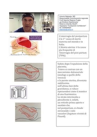 Schema che illustra i diversi metodi di trattamento per l'emorragia post-partum