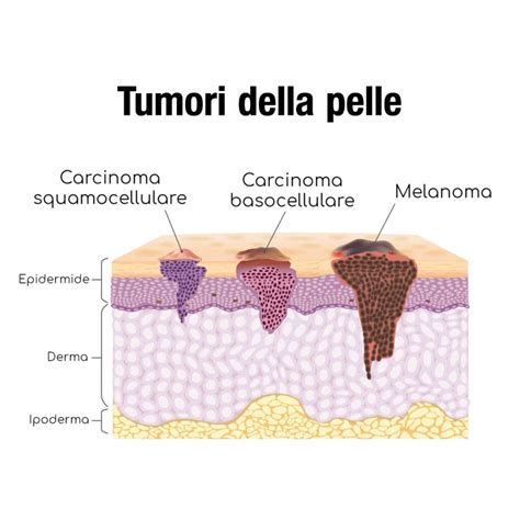 Schema dei tumori associati alla produzione di Beta-hCG