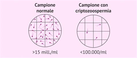 rappresentazione microscopica di un campione seminale con criptozoospermia