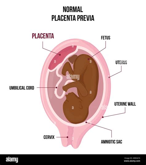 Schema della placenta previa