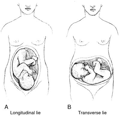 Diagramma della posizione trasversa (transverse lie)