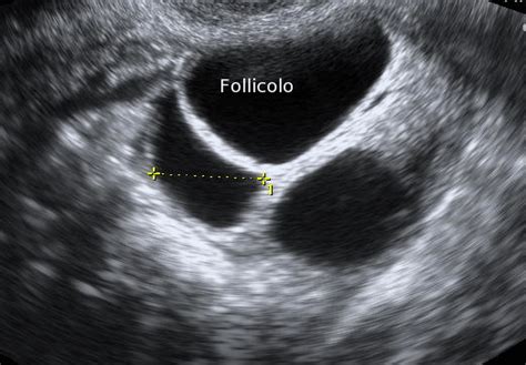 Ecografia transvaginale per il monitoraggio dei follicoli ovarici