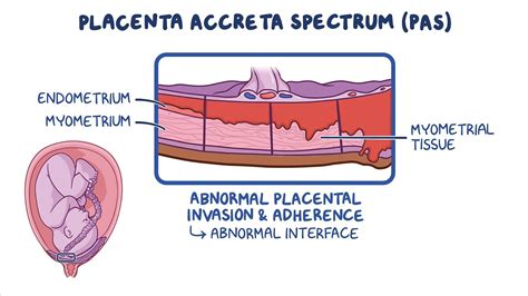 grafico che illustra l'aumento del rischio di placenta accreta in base al numero di cesarei pregressi