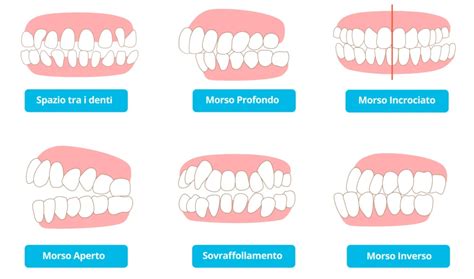 schema delle malocclusioni dentali causate da abitudini orali scorrette