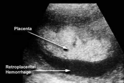 Fattori di rischio distacco di placenta