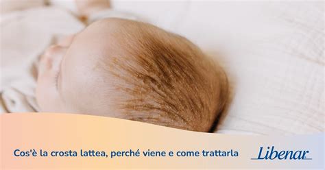 Crosta lattea sul cuoio capelluto di un neonato