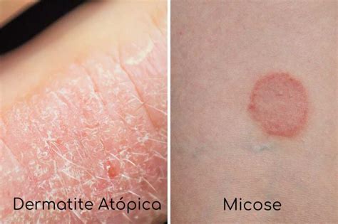 Dermatite atopica e crosta lattea a confronto