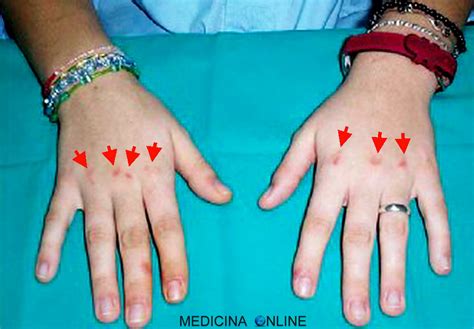 Dita con segni di Russell