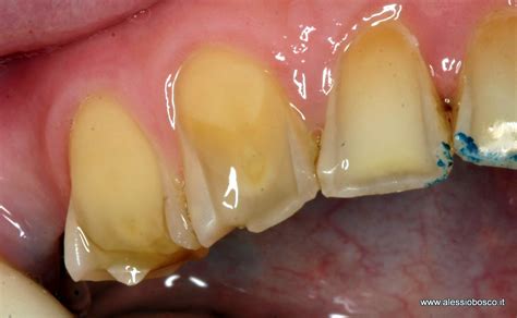 Erosione dentale da vomito autoindotto