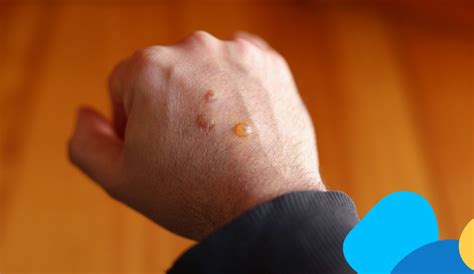 Tipiche vescicole sulla mano di un bambino affetto da mani-bocca-piedi