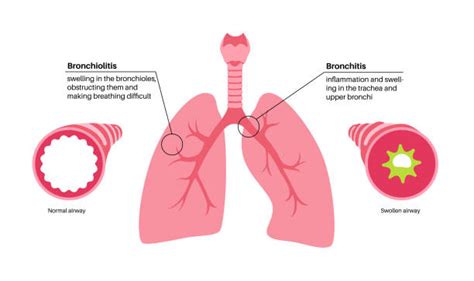 diagramma comparativo: caratteristiche principali di Bronchite, Bronchiolite e Pertosse