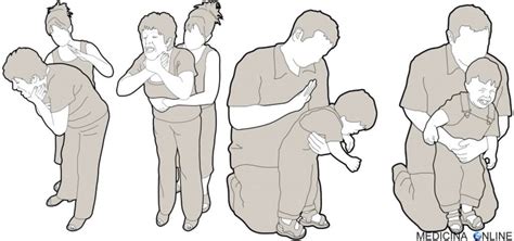 bambino che soffoca e manovra di Heimlich