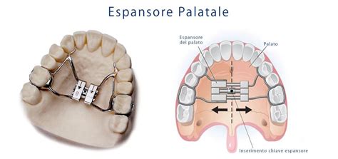 infografica che mostra la crescita dell'arco palatale e il ruolo del succhietto ortodontico