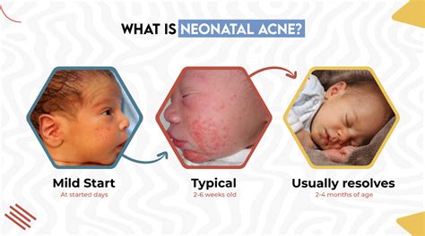 Confronto tra acne neonatale e acne infantile