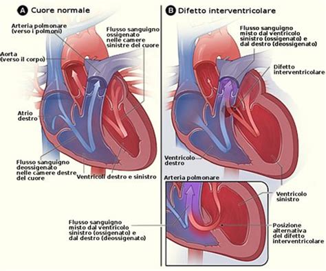 Ecocardiografia di un difetto del setto interventricolare