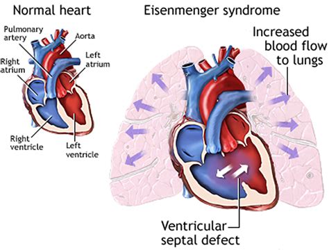 Sindrome di Eisenmenger: conseguenze di un DIV non trattato