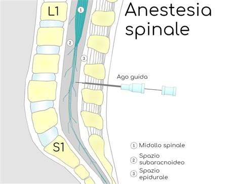 Schema comparativo tra anestesia spinale ed epidurale