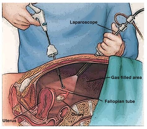 Laparoscopic ovarian tissue retrieval
