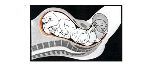 diagramma che illustra la discesa della testa del feto nel canale del parto