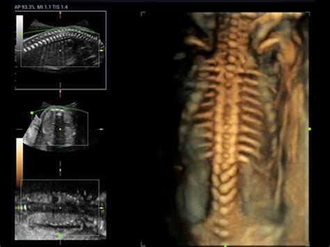 Rappresentazione ecografica della colonna vertebrale fetale