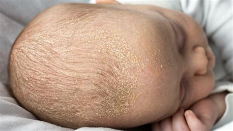 Bambino con crosta lattea