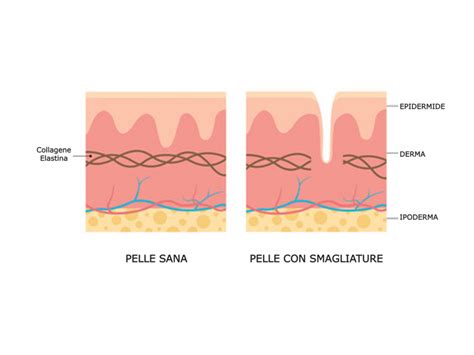 Diagramma della formazione delle smagliature