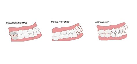 Illustrazione del morso aperto (open bite)