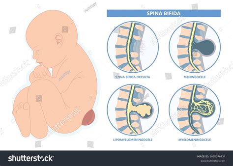 Rappresentazione della spina bifida, mostrando il midollo esposto e la successiva correzione chirurgica in utero