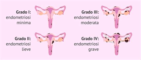 Schema che illustra il tessuto endometriale che cresce al di fuori dell'utero (endometriosi)