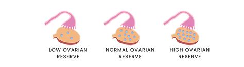 Treatment options for low ovarian reserve