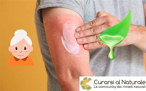 Rimedi naturali e prodotti per scottature solari