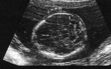 Immagine di un'ecografia fetale dettagliata del cranio