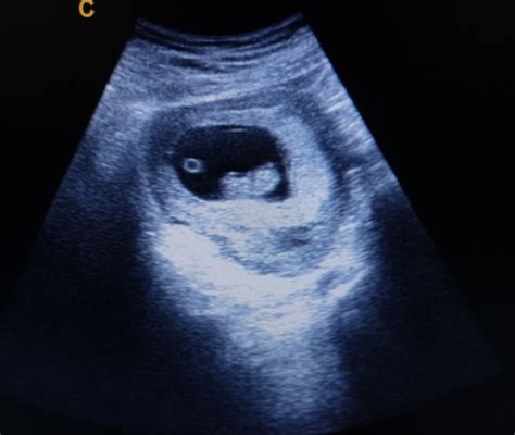 Immagine ecografica che mostra un embrione con battito cardiaco