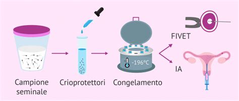 infografica che illustra il processo di crioconservazione dello sperma, dal prelievo allo stoccaggio