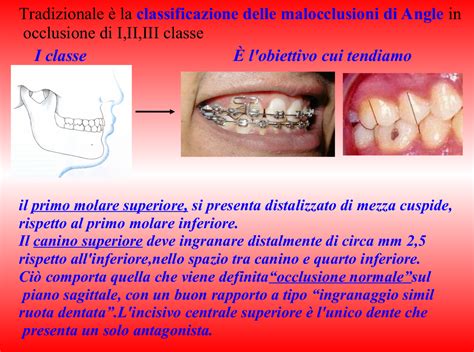 Schema delle malocclusioni