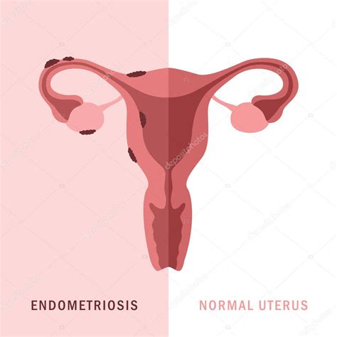 Illustrazione del tessuto endometriale dislocato e delle sue sedi comuni