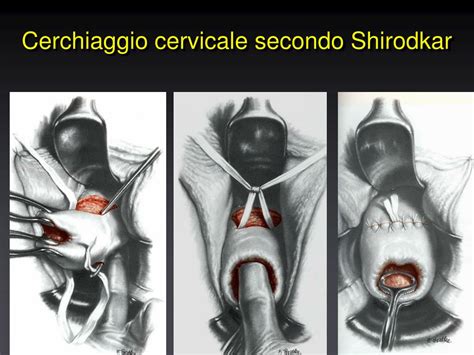 Schema del cerchiaggio cervicale