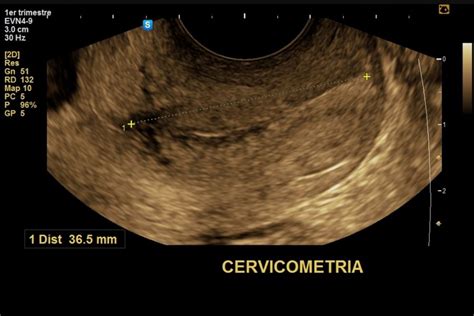 Ecografia per cervicometria: misurazione della lunghezza del collo dell'utero