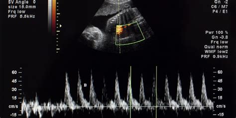 ecografia fetale che mostra il battito cardiaco