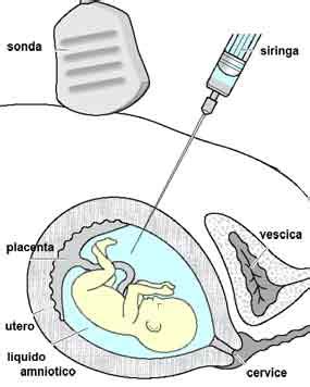 Immagine: Amniocentesi sotto controllo ecografico