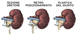 Rappresentazione grafica di un rene dilatato a causa di ostruzione del giunto pielo-ureterale