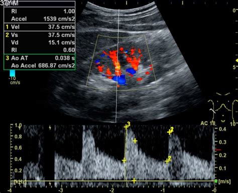 Immagine ecografia doppler flusso placentare