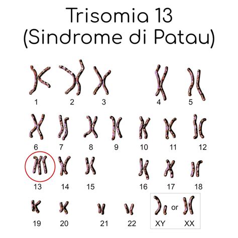 Grafico sulla sopravvivenza nella trisomia 13
