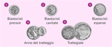 Schema comparativo di una blastocisti e i suoi gradi di espansione