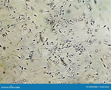 Microscopic view of sperm affected by infection