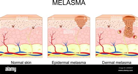 Maschera della Gravidanza (Melasma)