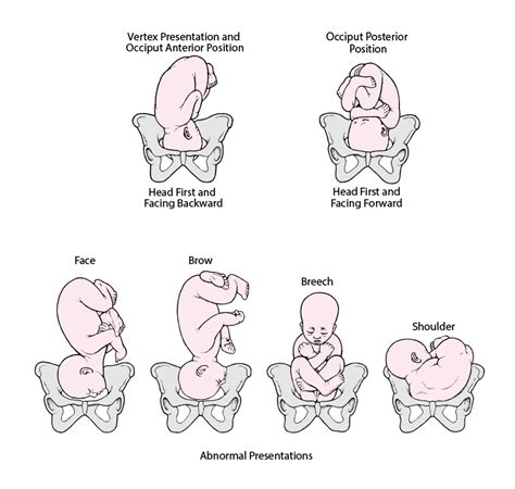 Illustrazione della presentazione facciale fetale